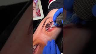 Eye tattoo - EMALLA Cartridge
