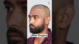 Six Months Hair Transplant Results | Latest Fue Technique #shorts #viral #hair transplant