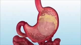 INFLATION OF THE INTRAGASTRIC BALLOON