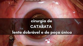 Cirurgia de Catarata de verdade | Dr Emmerson Badaró | Viver oftalmologia