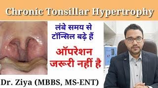 Tonsil badhne per kya Surgery zaruri hai? Tonsil badhna. Chronic Tonsillar Hypertrophy.