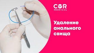 Операция по удалению свища прямой кишки