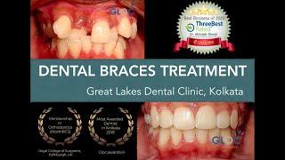 Best Dental Braces Clinic in Kolkata | Crooked teeth | Best Orthodontic Treatment in Kolkata