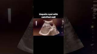 calcified hepatic cystic wall#medicalimaging #ultrasound #imaging #medicine