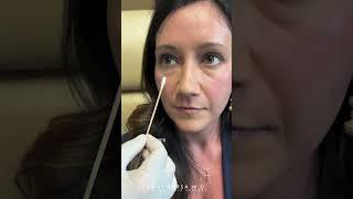 Removing Under Eye Filler Journey | with Dr. Kami Parsa