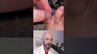 Derm reacts to sneaky hair splinter! #dermreacts #doctorreacts #hairsplinter