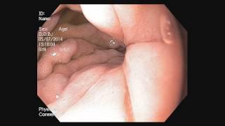 GASTRIC VARICES HD vs SD - CV 180