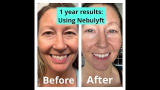 MY AMAZING 1 YEAR RESULTS USING NEBULYFT N1 MIRCO RF ANTI AGING DEVICE: BEFORE AND AFTER