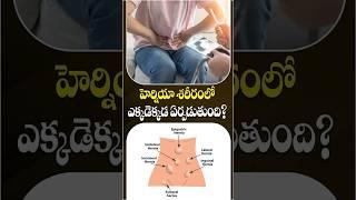 What Is Hernia In Telugu | When Treatment Is Needed For Hernia | Renova #shorts #hernia