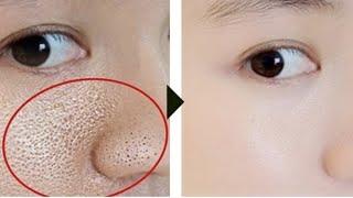 How to remove blackheads on the face