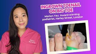 Ingrown Toenail on Big Toe? Treatment by Miss Foot Fixer Marion Yau London Uk