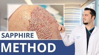 What Is The Sapphire Hair Transplant? | Dr. Balwi Explains