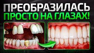 Все были в ШОКЕ! Сделали зубы пациентке – ДО и ПОСЛЕ