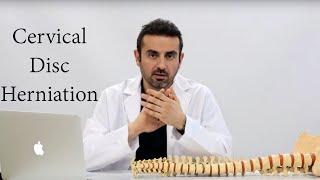 CERVICAL DISC HERNIATION