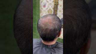 Hair patch life.Hair wig. Hair wig for men.hair patch for men. Hair patch in Kolkata.Frontless patch