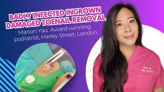 Badly Infected Ingrown damaged Toenail Removal by Miss Foot Fixer Marion Yau