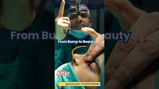 @drsuniltanvar  Reshapes Nose Bump with EXPERT Rhinoplasty Skills!