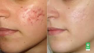 HIRUDOTERAPIA - Dr Mihaela Diculescu
