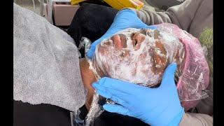 Microneedling Treatment