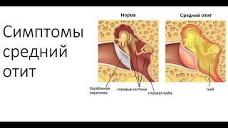 Отит симптомы. Какие симптомы мы наблюдаем при средних отитах.