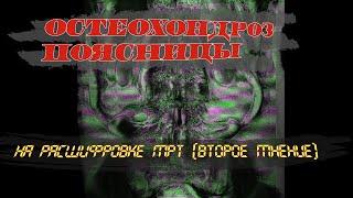 ОСТЕОХОНДРОЗ пояснично крестцового отдела позвоночника.  ОСТЕОХОНДРОЗ ПОЯСНИЦЫ на МРТ расшифровке