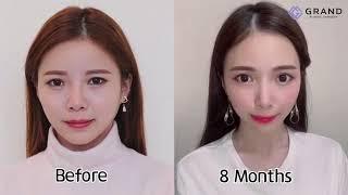 [Grand Plastic Surgery] Tip plasty/ rhinoplasty/ nose job/ revision surgery