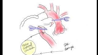 schema of kommerell's diverticulum