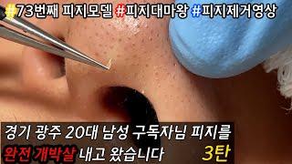 피지 직접 뽑아드렸습니다 _ 피지제거 블랙헤드제거 피지뽑기 _ 경기 광주시에 사는 20대 남자구독자님의 쫀쫀한 피지 정복 프로젝트 3탄