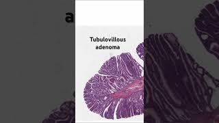 Tubulovillous adenoma (colon polyp under microscope)