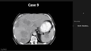 Indeterminate splenic masses by Dr. Khalid Elsayes delivered at ICIS 2021