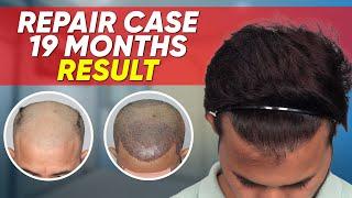 Hair Transplant in Turkey | Best Results & Cost of Hair Transplant in Turkey