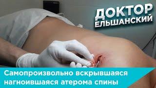 Самопроизвольно вскрывшаяся нагноившаяся атерома спины операция