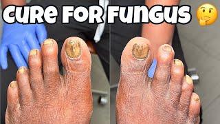 FUNGAL TOENAIL TREATMENT
