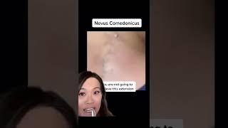 How do you avoid getting these blackheads and whiteheads? 