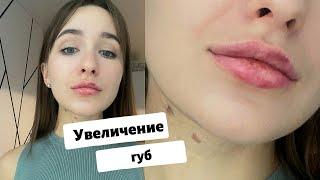 УВЕЛИЧЕНИЕ ГУБ / мой опыт с ФОТО / ВСЯ ПРАВДА И ПОСЛЕДСТВИЯ!