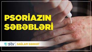 Psoriaz nədir? / Psoriazın səbəbləri / Psoriazın Müalicəsi