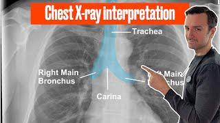 Chest X ray interpretation (in 10 minutes) for beginners #chestxray #cxr