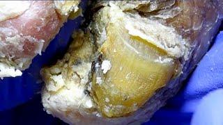 The Toenails Are Gradually Covered With Fungus And Are Slowly Removed【Dr. Liu's Pedicur】