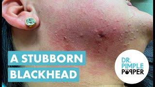 Dr Pimple Popper Helps With Blackhead Cyst