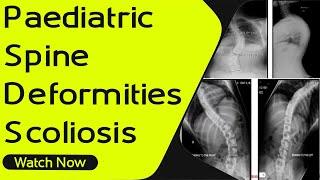 Pediatric Spine Deformities - Scoliosis | Orthopaedic Academy