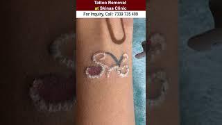 Tattoo removal at skinaa clinic #shorts