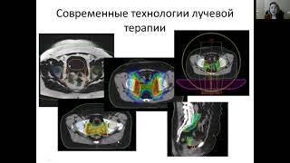 Адъювантная лучевая терапия рака эндометрия