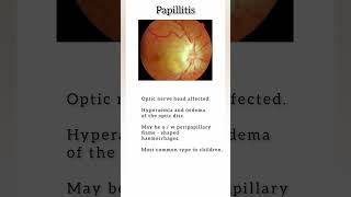 Optic neuritis     #optom #medicos #optometrists #nero#ophthalmology