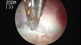 Hystroscopic metroplasty of short septum by Dr/ waleed almery