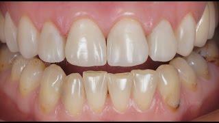 Реставрация передних зубов. Front teeth restoration. Capo Natural (Schutz).