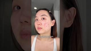 The truth hurts  #acne