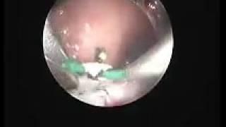 Hystroscopic resection of uterine septum by Dr/ waleed almery