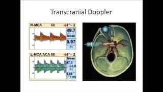 Natus TCD Webinar: Performance of the Normal TCD Examination