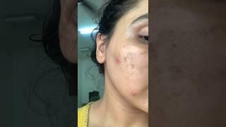 Best serum for pigmentation , review after 2weeks #viral #trending #makeup #foxtale