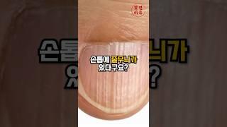 손톱에 세로줄이 있다면?
